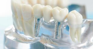 Протезирование зубов – это повышения качества жизни